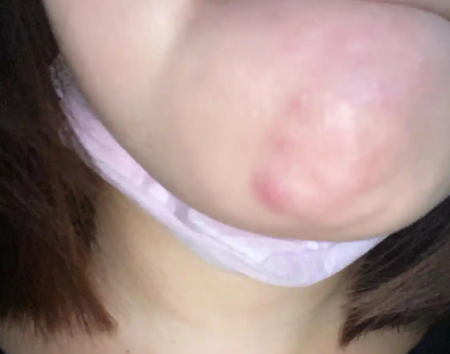Sudden Hardness and Swelling After Chin Filler? Causes and Emergency Response Guide