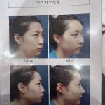 隆鼻踩雷全紀錄｜這三個錯誤讓你的鼻子白做了